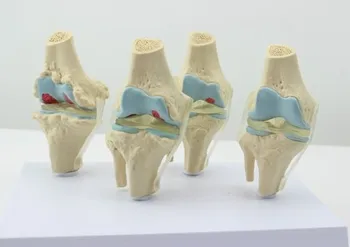 модель патологического состояния коленного сустава человека, модель остеопороза скелета человека, бесплатная доставка